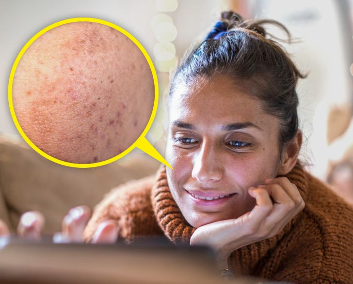 7 nguyen nhan khien mat ban xuat hien tan nhang