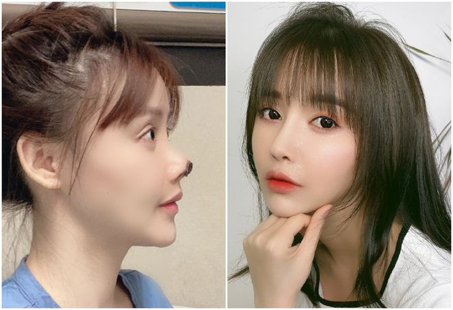 Từ một mỹ nhân sở hữu nhan sắc trong trẻo, khả ái, vậy nhưng chỉ vì nghe lời bạn đi thẩm mỹ, người đẹp nhận trái đắng khi chiếc mũi trở nên biến dạng, chịu nhiều biến chứng.