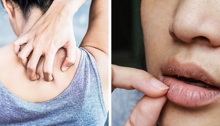 Giảm viêm: Dầu ô liu hoạt động như một chất kháng viêm, giúp giảm viêm, ngăn ngừa và hỗ trợ chữa lành các tình trạng viêm da.