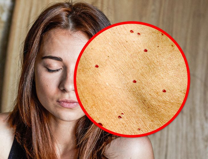 7. Nhiều nốt ruồi đỏ trên mặt: Những nốt ruồi đỏ này còn gọi là u máu quả anh đào (cherry angiomas), thường xuất hiện ở những người trên 30 tuổi và ngày càng tăng số lượng ở những người ngoài 40 tuổi.