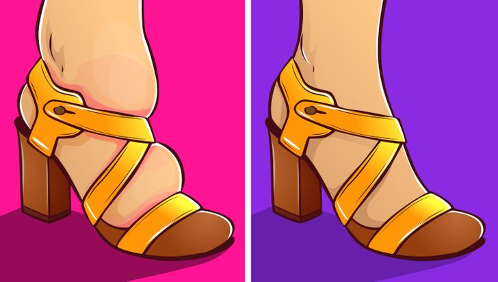 Đi giày chật: Mang giày sai kích cỡ không chỉ không thoải mái mà còn có thể gây tổn thương cho móng chân. Nếu giày tác động quá mạnh vào móng, nó có thể dẫn đến chấn thương móng và thậm chí có thể khiến móng tách ra khỏi lớp móng.