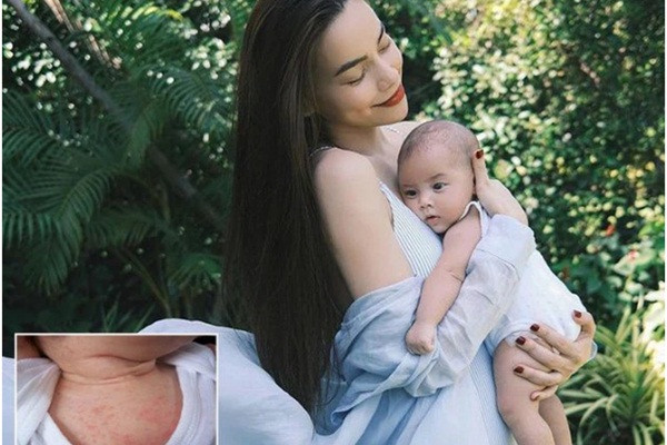 Con gai Ha Ho man do khap nguoi: Nguyen nhan, xu ly the nao?-Hinh-2