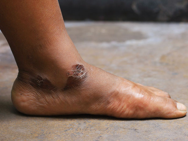 Làm lành vết thương: Vitamin C của chanh và curcumin trong nghệ đều có khả năng chữa lành vết thương. Cả hai hợp chất đều tăng cường sự biểu hiện của collagen bởi các nguyên bào sợi, giúp tăng cường sự hình thành mô hạt và chữa lành vết thương với tốc độ nhanh hơn. Ngoài ra, chúng còn giúp ngăn ngừa nguy cơ nhiễm trùng vết thương do hoạt động kháng khuẩn của chúng.