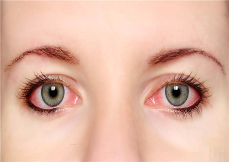 Bệnh glaucoma (còn gọi là cườm nước) là một bệnh ở mắt do áp lực nội nhãn tăng cao chèn ép thị thần kinh làm tổn thương thần kinh thị giác dẫn đến tình trạng mất dần thị lực.