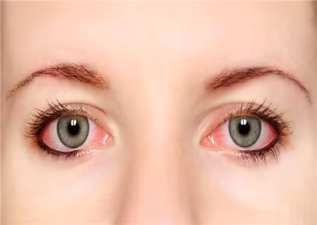 Bệnh glaucoma (còn gọi là cườm nước) là một bệnh ở mắt do áp lực nội nhãn tăng cao chèn ép thị thần kinh làm tổn thương thần kinh thị giác dẫn đến tình trạng mất dần thị lực.