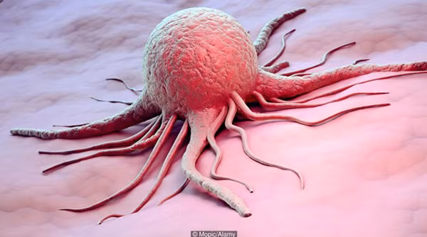 Thiếu protein dễ khiến ung thư dạ dày: Ung thư dạ dày được gọi với cái tên "căn bệnh nghèo" bởi theo điều tra dịch tễ học, người mắc ung thư này có liên quan đến chế độ ăn nghèo dinh dưỡng, đặc biệt là thiếu proein.