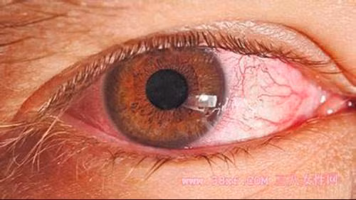 Còn nếu đã mắc glaucoma mãn tính có thể gặp các triệu chứng như: Giảm thị lực từ từ, khó phát hiện, giảm thị lực khi vào nơi thiếu ánh sáng, nhức đầu, cảm giác nặng mắt khi làm việc nặng, nhức mắt kèm đỏ mắt nhẹ, nhìn mờ như sương mù, thấy quầng xanh khi nhìn đèn.