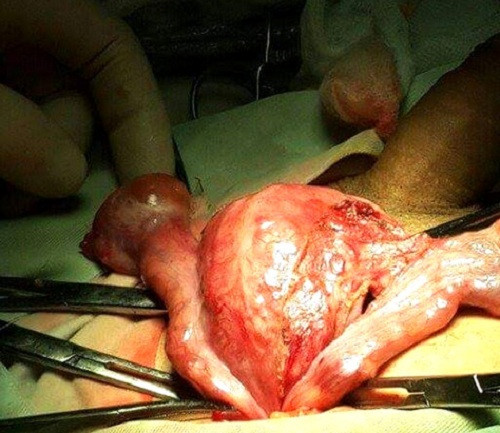 Hy huu truong hop mang co quan sinh san sai gioi tinh