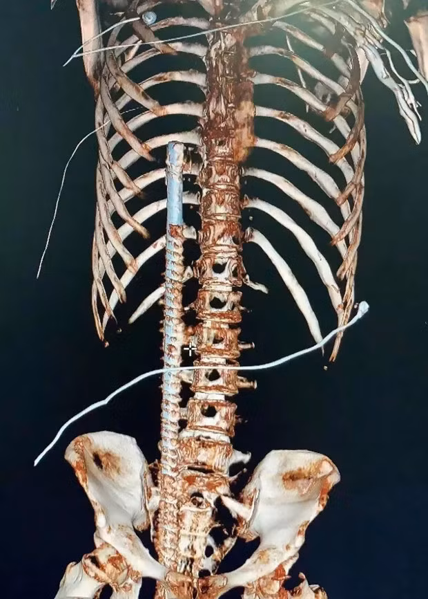 Bị thanh sắt xoắn đâm xuyên người, thanh niên thoát chết thần kỳ - Hình 2 Bi thanh sat xoan dam xuyen nguoi, thanh nien thoat chet than ky-Hinh-2