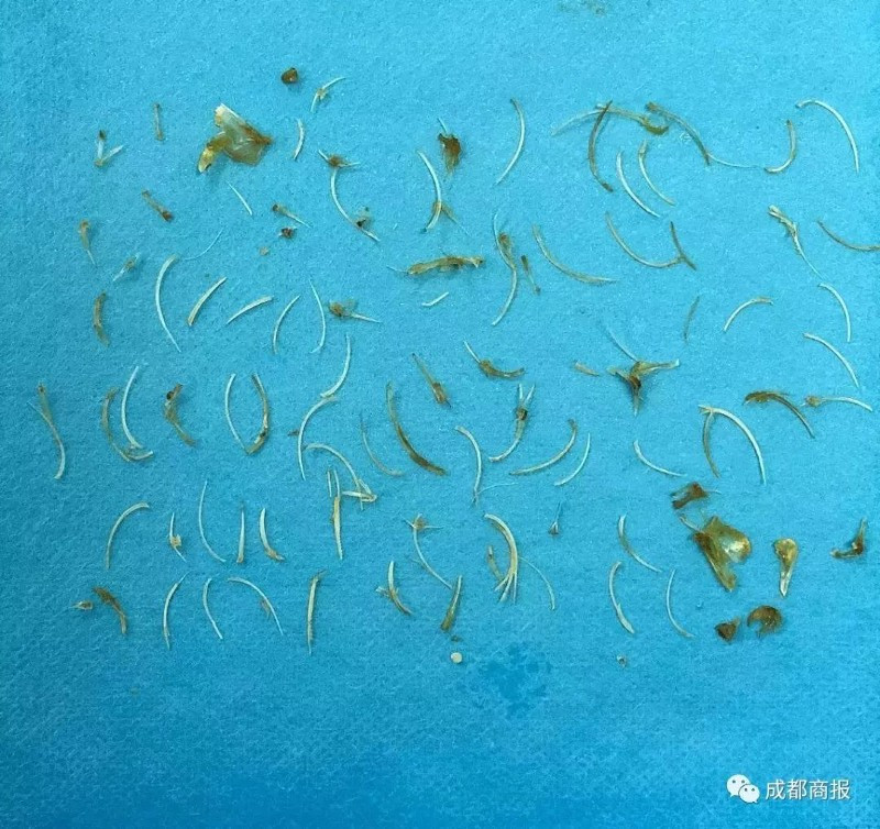 100 xương cá được lấy ra từ bụng của Zhou.