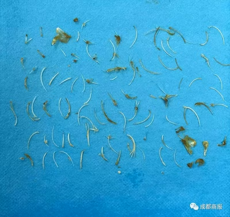 100 xương cá được lấy ra từ bụng của Zhou.