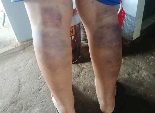 Cô giáo đánh nam sinh bầm tím 2 chân bị kỷ luật cảnh cáo Co giao danh nam sinh bam tim 2 chan bi ky luat canh cao