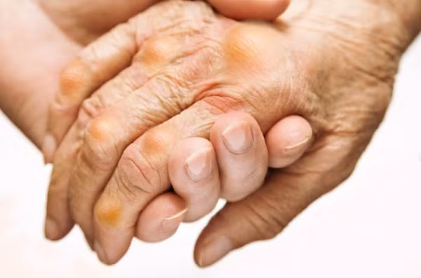 Đặc biệt, các thành phần dinh dưỡng trong nước hầm đậu làm giảm axit uric trong máu và chất lắng đọng của các tinh thể axit uric ở thận, khớp. Ảnh: Heathplus.