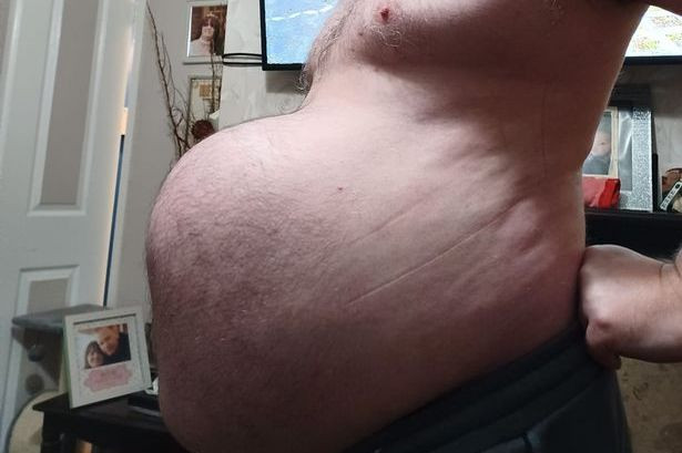 Hoan phau thuat vi dich, nguoi dan ong phai mang “bung bau 9 thang”