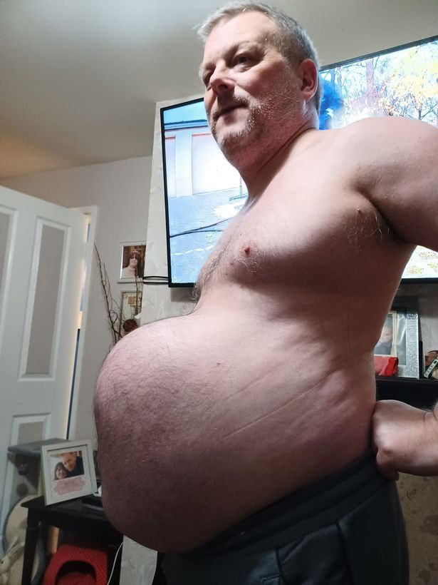 Hoan phau thuat vi dich, nguoi dan ong phai mang “bung bau 9 thang”-Hinh-2