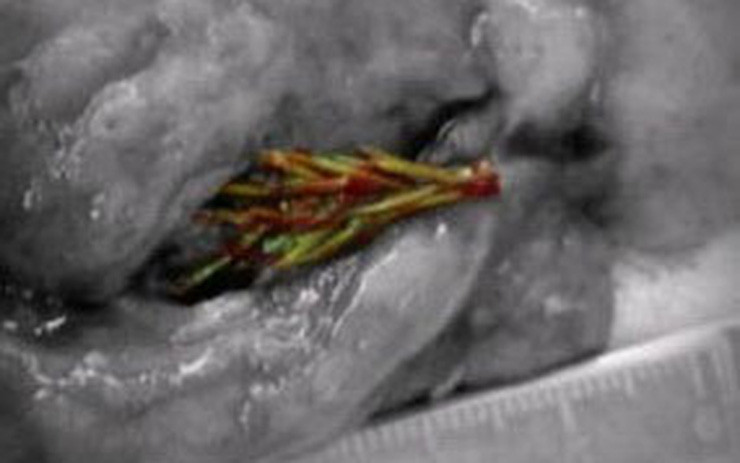 Nguoi dan ong ho ra mau, bac si soc vi thu ben trong phoi-Hinh-2