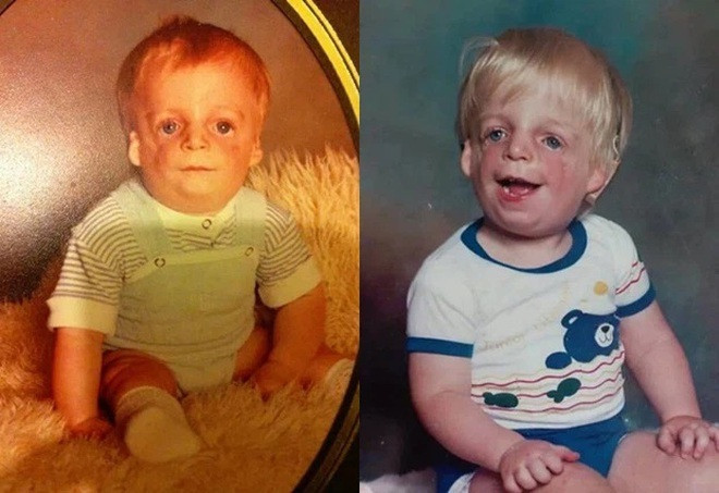 Jono Lancaster (sinh năm 1985 ở Anh) bị bố mẹ đẻ vứt bỏ sau khi vừa chào đời được 36 tiếng. Nguyên nhân là vì Jono bị chẩn đoán mắc hội chứng Treacher Collins khiến gương mặt xấu xí.