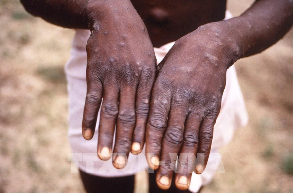 Benh dau mua khi lay nhiem nhu the nao?