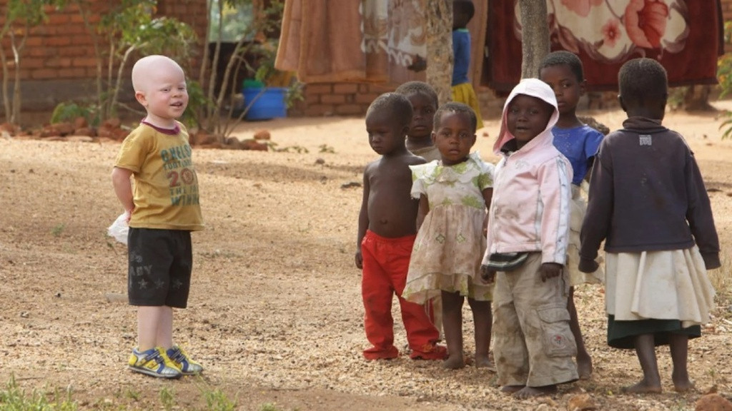 Đây cũng là lý do khiến người bạch tạng thường phải sống trong bất an, lo lắng, thậm chí là sợ hãi. Để bảo vệ nhóm người này, giới chức trách các nước châu Phi và nhiều tổ chức quốc tế thực hiện những chiến dịch nhằm tuyên truyền cho công chúng hiểu đúng về người bạch tạng. Thông qua những chiến dịch hành động này, giới chức trách mong muốn người bạch tạng có cuộc sống tốt hơn.