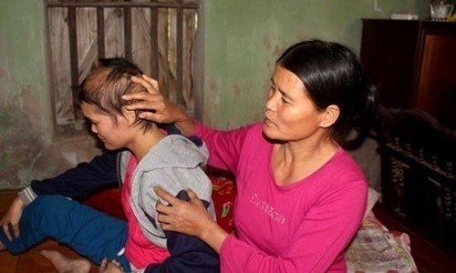 Bà Tuyết đớn đau nhìn con gái đang giành giật sự sống từ căn bệnh tử thần.