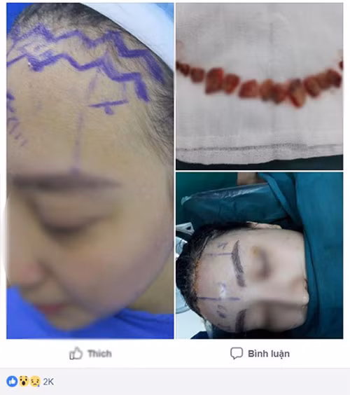 Rùng mình dịch vụ... cắt bỏ da đầu để sửa trán bớt cao Rung minh dich vu... cat bo da dau de sua tran bot cao