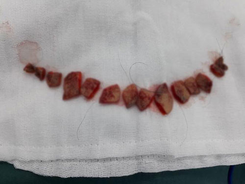 Rung minh dich vu... cat bo da dau de sua tran bot cao-Hinh-3