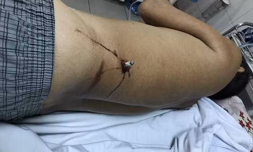 Thanh sắt đâm xuyên người cụ ông