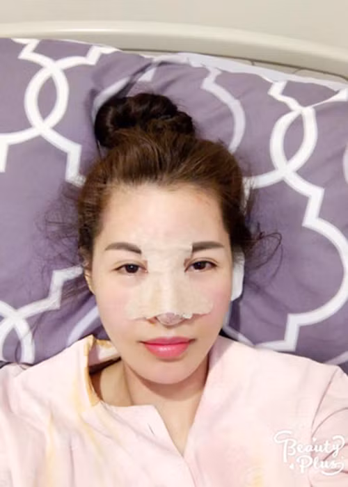 Chưa hài lòng với gương mặt, Quế Vân đập mặt lần 2 chỉ sau 3 tháng dao kéo lần đầu tiên.