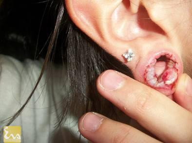 Canh bao nguy co bien chung phu tai vi bam lo tai-Hinh-2