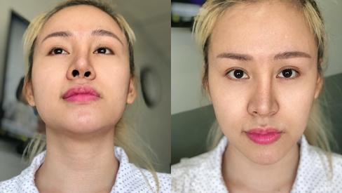 Lê Thị Huyền Anh từng gây sốc với chiếc mũi biến dạng sau nhiều lần "dao kéo".