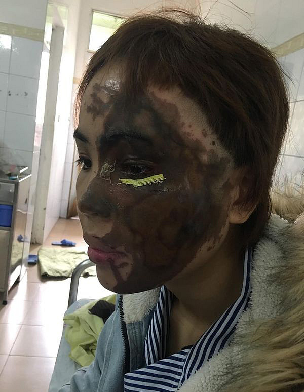 Hanh trinh hoi sinh guong mat cho co gai bi thieu uy tat axit-Hinh-2