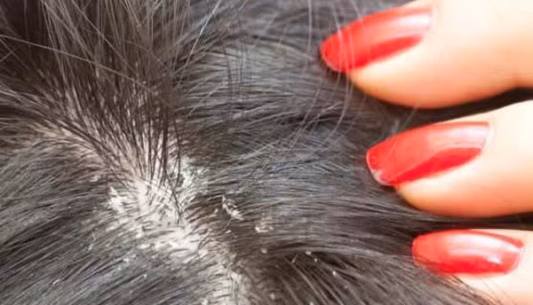 Nếu tóc khô và nhiều gàu, bạn nên nghĩ tới việc tận dụng tinh bột nghệ để cải thiện tình hình bởi các chất trong nghệ có khả năng giảm viêm nhiễm, tiêu diệt vi khuẩn cùng các loại nấm gây nên tình trạng này.