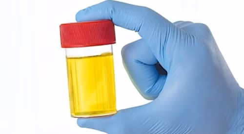 Sự thay đổi ở nước tiểu cũng là một trong những dấu hiệu bệnh thận đáng ngờ song lại hay bị bỏ qua. Nếu vẫn duy trì chế độ ăn uống bình thường song nước tiểu trở nên có mùi lạ, màu nhạt hoặc tối hơn, tăng hoặc giảm bất thường số lần đi vệ sinh trong ngày.