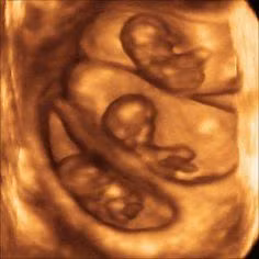 Với những trường hợp sinh ba trở nên, mổ đẻ thường là bắt buộc vì hiếm khi nào cả ba bé đều có thể quay đầu trong bụng mẹ một cách hoàn hảo được.