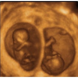 Các bé sinh đôi thường có tư thế nằm trong bụng mẹ không giống nhau. Quá trình quay đầu để chuẩn bị "chui ra" có thể diễn ra ở một hoặc hai bé hoặc thậm chí không diễn ra.