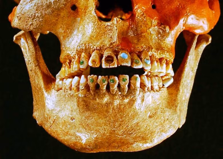 Gắn đá quý lên răng là cách làm đẹp khá phổ biến ngày nay nhưng trong quá khứ người ta thường chọn những viên kim cương rất lớn và không sử dụng keo để gắn mà dùng... búa để đóng những viên này vào răng.