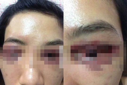 Suyt hong mat khi cat mi va loat tai nan vi phau thuat tham my