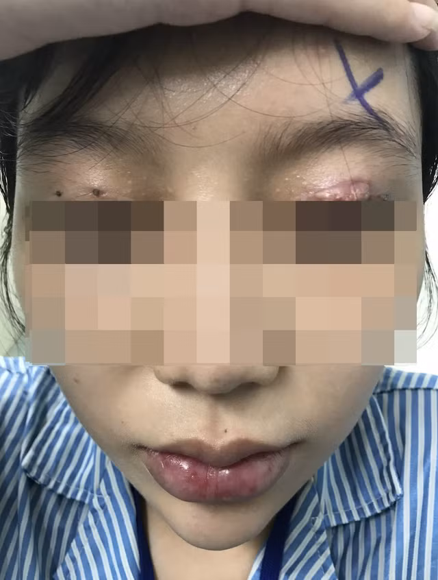 Suyt hong mat khi cat mi va loat tai nan vi phau thuat tham my-Hinh-2