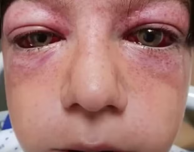 Một cậu bé suýt mù mắt vì học theo các trò trên youtube.