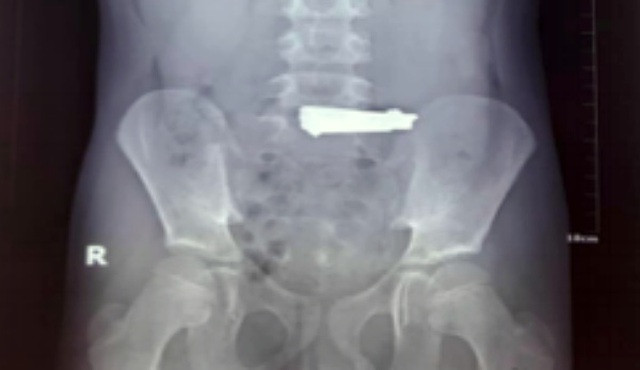 Cậu bé cho biết học theo các video trên youtube nên đã nuốt bấm móng tay vào bụng.