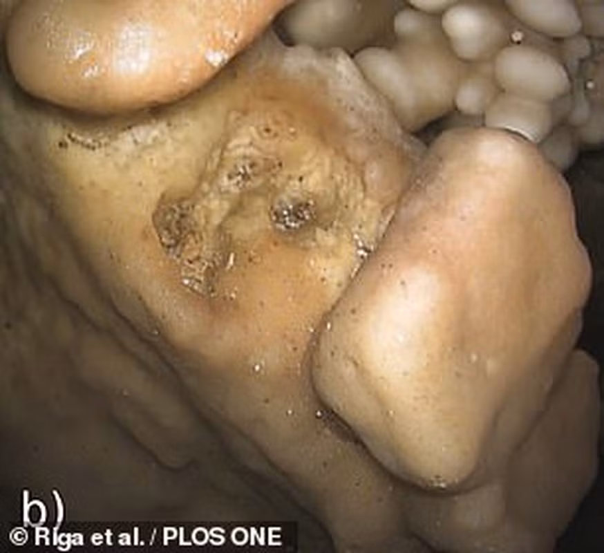 Giống những người Neanderthal khác, răng cửa của Altamura Man lớn hơn răng của người hiện đại nhưng răng hàm lại có kích thước tương đương. Trước hết, bộ hàm với một số phần mềm được bảo quản nguyên vẹn còn tiết lộ bệnh nướu răng và tình trạng vôi răng mà người đàn ông mắc phải.