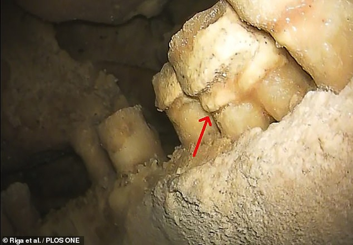 Altamura Man được cho là đã ngã xuống một hố sâu do không nhìn thấy nó. Sự cố này khiến ông tìm được lối thoát hoặc có người tới cứu giúp nên đã tử vong vì đói khát trong hố sâu - một cái chết đau đớn.