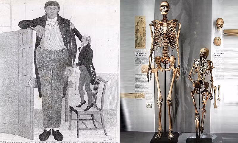 Chỉ vì thân hình quá khổ của mình mà Charles Byrne đã phải gặp nhiều rắc rối trong cuộc sống. Thậm chí đến khi ông chết mọi người vẫn luôn bàn tàn về ông.