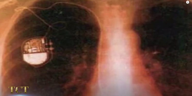 Điều gây chấn động ở đây là dù trái tim 2.500 năm này đã khô quắt như "thịt bò khô" nhưng nó vẫn có thể đập như máy điều hòa nhịp tim. Sau khi đo lường, các bác sĩ đếm được 80 nhịp/phút. (Ảnh: TCT)