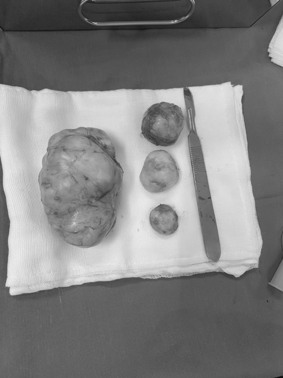 Tưởng béo bụng, đi khám phát hiện 4 khối u to Tuong beo bung, di kham phat hien 4 khoi u to