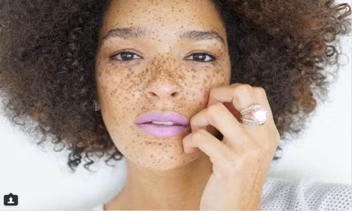 Người mẫu người Mỹ Nikia Phoenix nổi bật so với những người khác nhờ những chấm tàn nhang bao phủ toàn bộ cơ thể mình. Cô được một công ty thời trang chú ý và mời làm người mẫu. Hiện tại cô đang là gương mặt quen thuộc, xuất hiện nhiều trong các chiến dịch quảng cáo của Coca-Cola và Target.