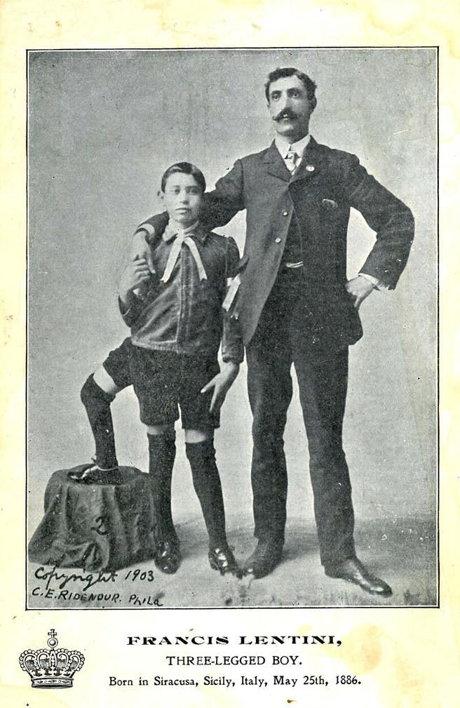 Thế nhưng, khi trưởng thành, ngoại hình này đã giúp Lentini có được một công việc trong gánh xiếc. Vào thời điểm ấy, những người có ngoại hình đặc biệt trở thành ngôi sao trong các buổi biểu diễn thu hút đông khán giả tới xem.