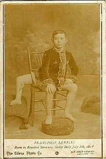 Việc có 3 chân khiến Lentini gặp nhiều khó khăn và bất tiện trong cuộc sống hàng ngày. Ông từng cảm thấy xấu hổ, tự ti vì ngoại hình. Thêm nữa, nhiều người xung quanh trêu chọc cơ thể dị thường của Lentini.