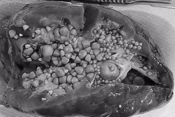 Bác sĩ cảnh báo nhiều người phải cắt thận vì thói quen nguy hiểm này Bac si canh bao nhieu nguoi phai cat than vi thoi quen nguy hiem nay