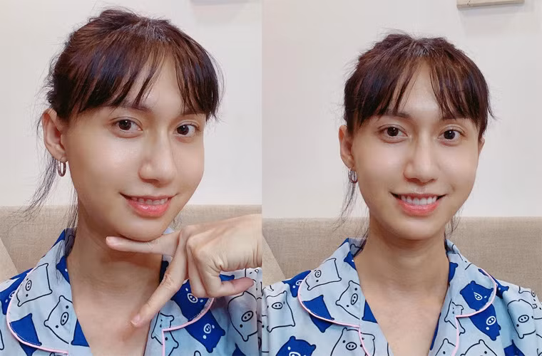 Để tự tin hơn, từ năm 2018, Lynk Lee đã âm thầm tiêm filler tạo hình má babay. Năm 2019 anh lại nhấn mí, sửa mũi, để tóc dài và ăn mặc với phong cách nữ tính hơn.